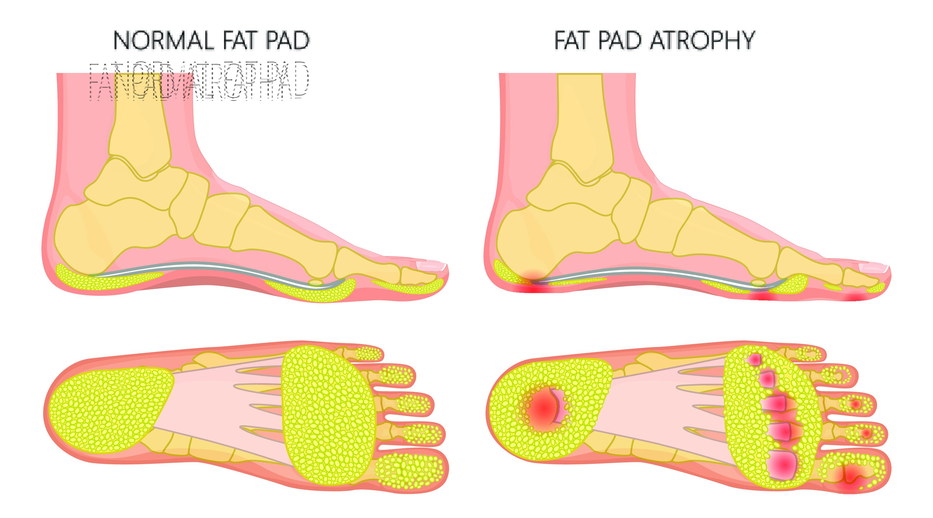 Can You Treat Fat Pad Atrophy With Orthotics? - Upstep Answers