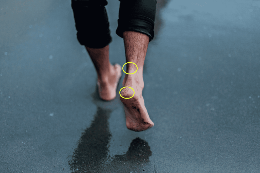 foot bursitis - particular in achilles tendon and calcaneal