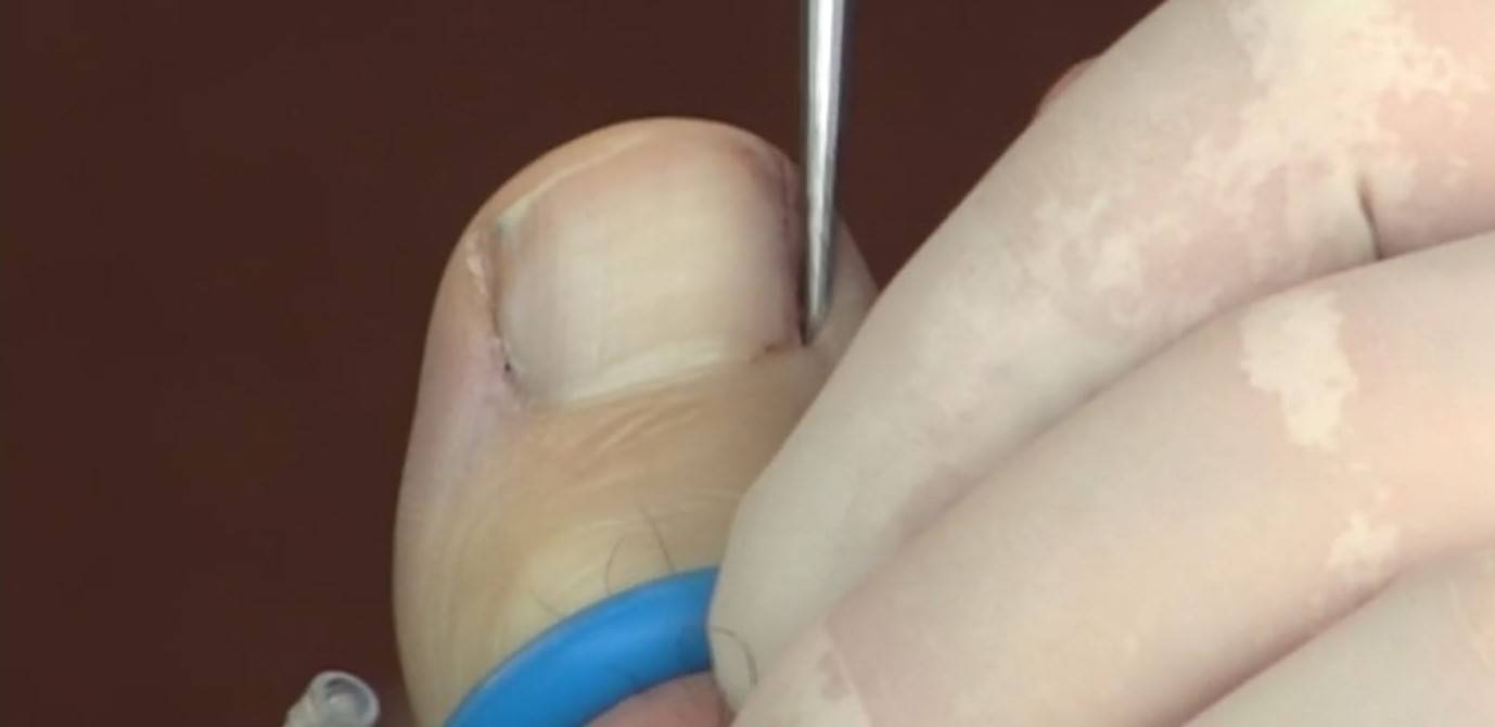 Ingrown nail surgery - wikidoc