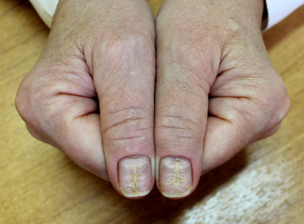 A Case Of Median Canaliform Nail Dystrophy