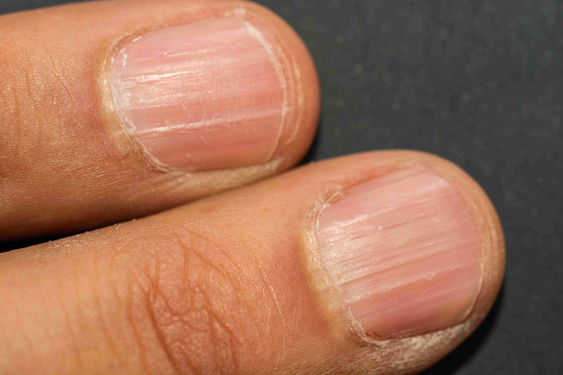 What causes black lines in nails How can you treat it  Quora