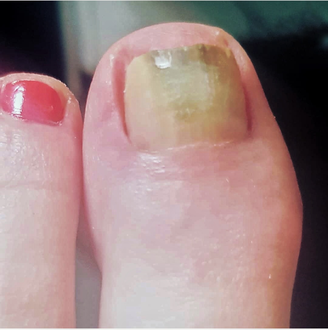 Fungal Nail Infection Image & Photo (Free Trial) | Bigstock