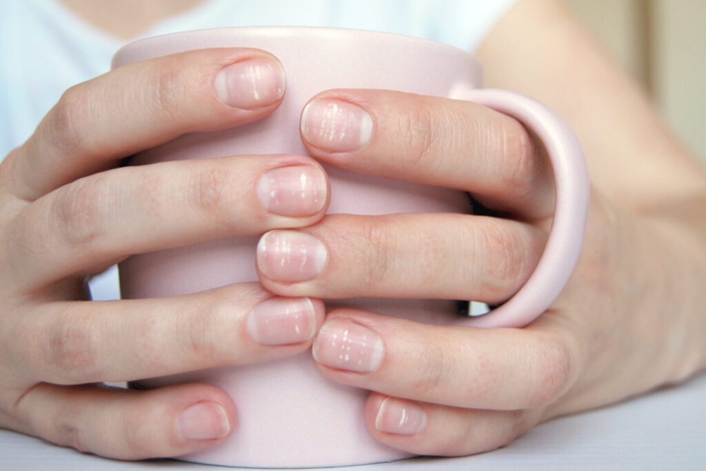 Many White Spots On Fingernails (leukonychia) Due To Calcium Deficit