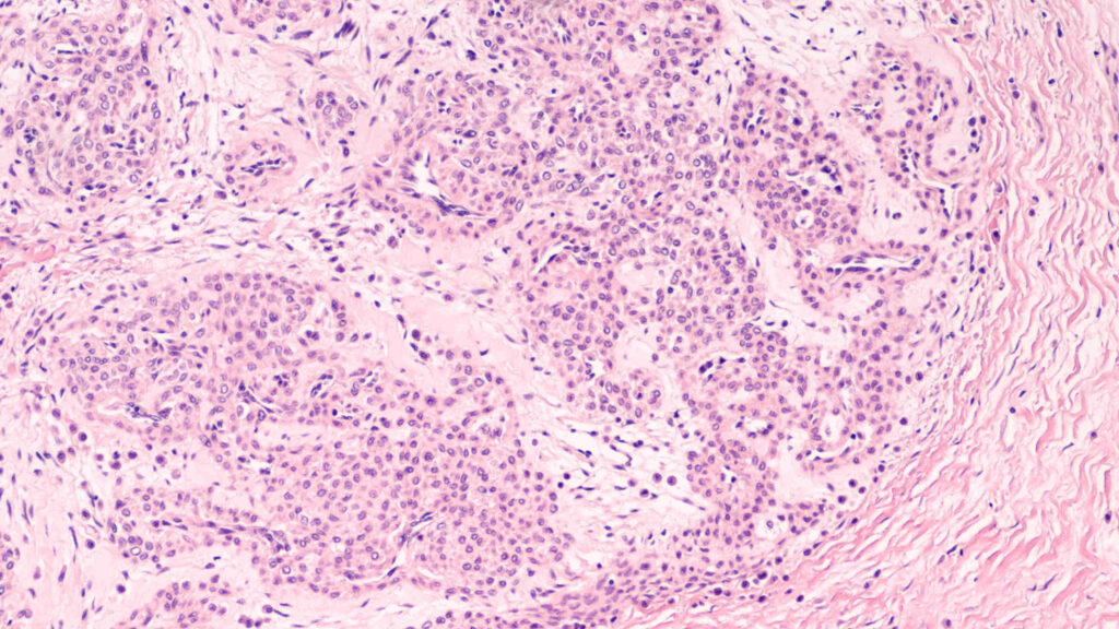 Microscopic Image Of A Glomus Tumor - A Painful Benign Tumor