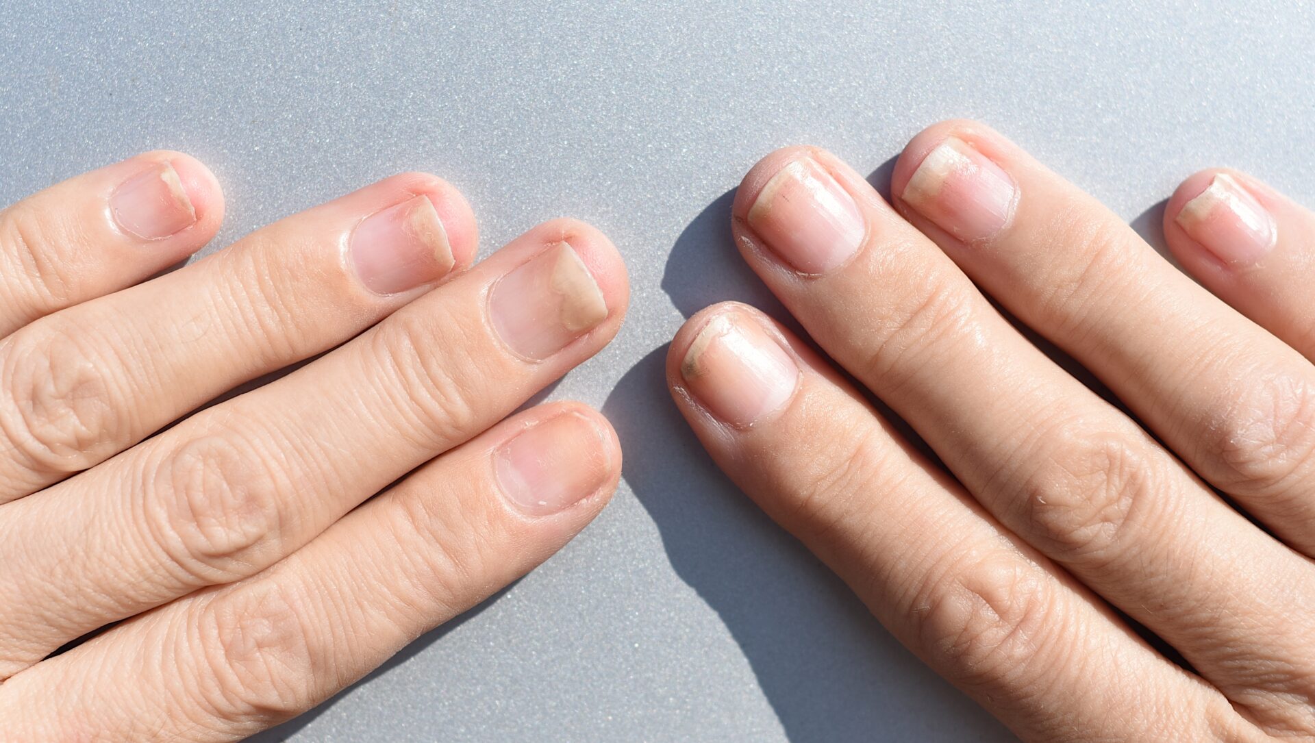 Nail Clinic: Help Clients With Arthritis | Nailpro